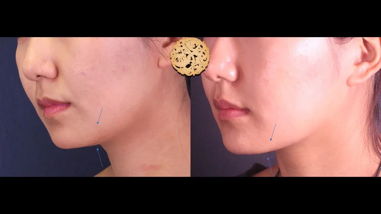 Kybella Before & After