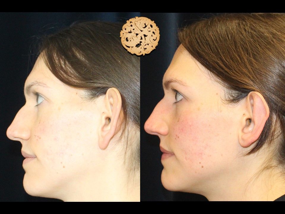 Earlobe Reduction Repair Before & After