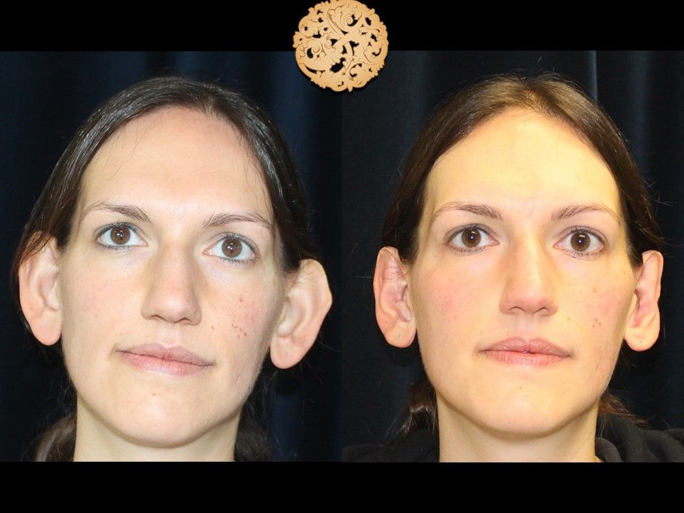 Earlobe Reduction Repair Before & After