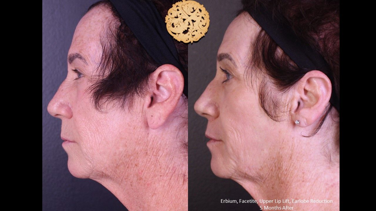 Earlobe Reduction Repair Before & After