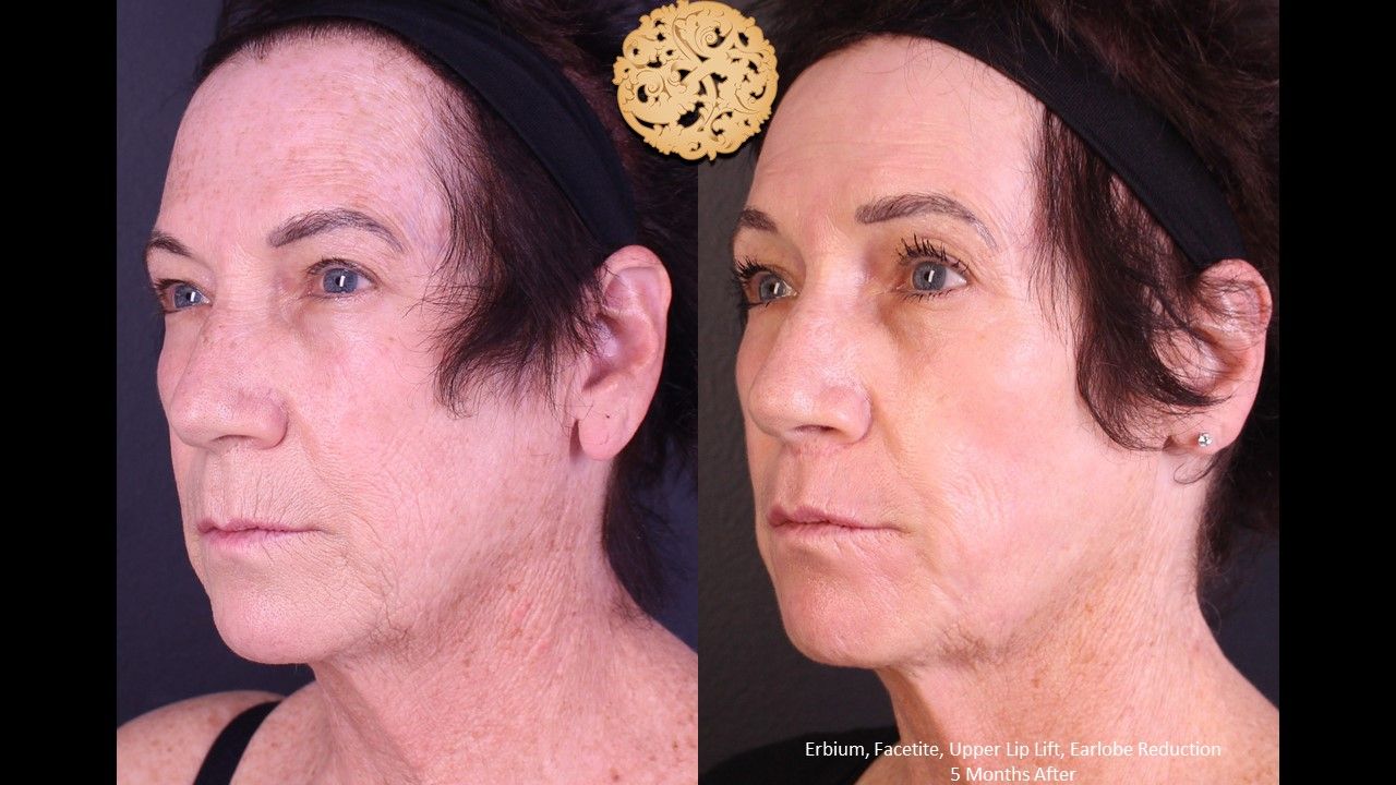 Earlobe Reduction Repair Before & After