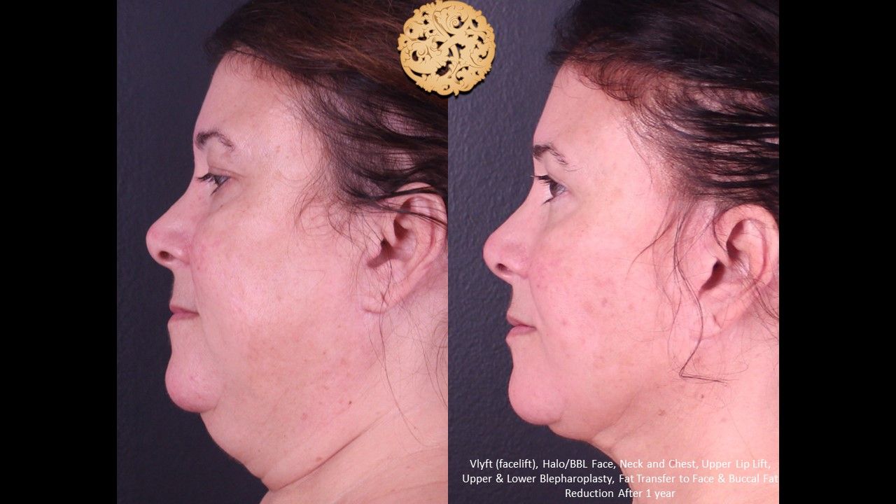 Facelift Neck Lift Before & After
