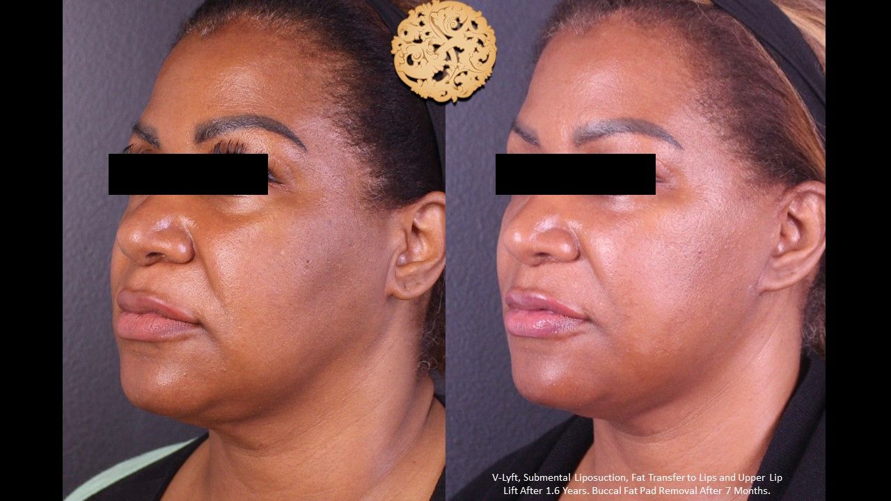 Facelift Neck Lift Before & After