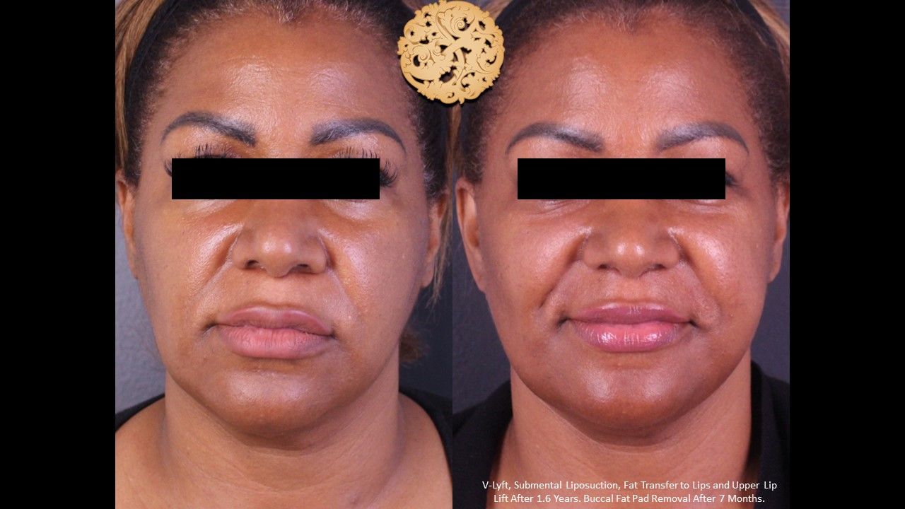 Facelift Neck Lift Before & After