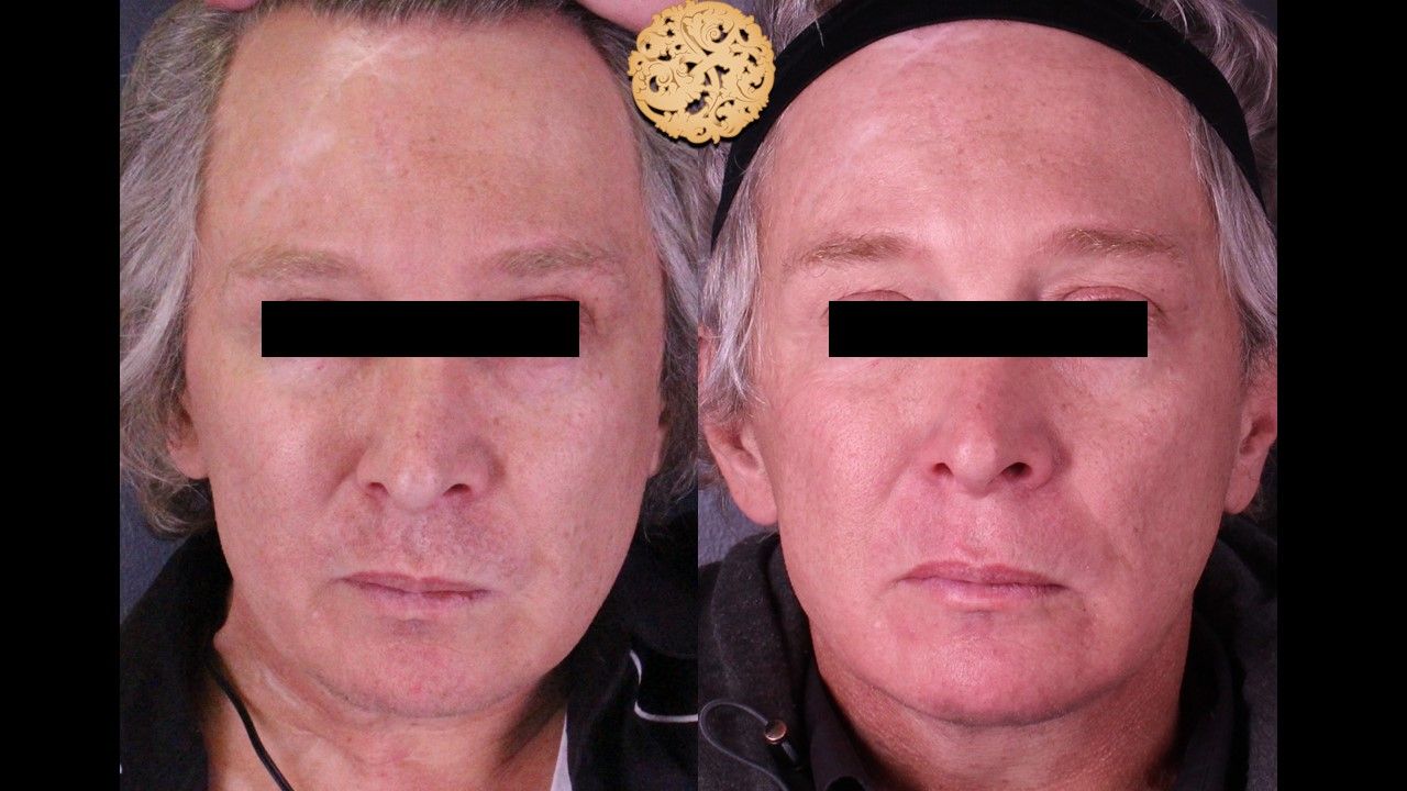 Facelift Neck Lift Before & After