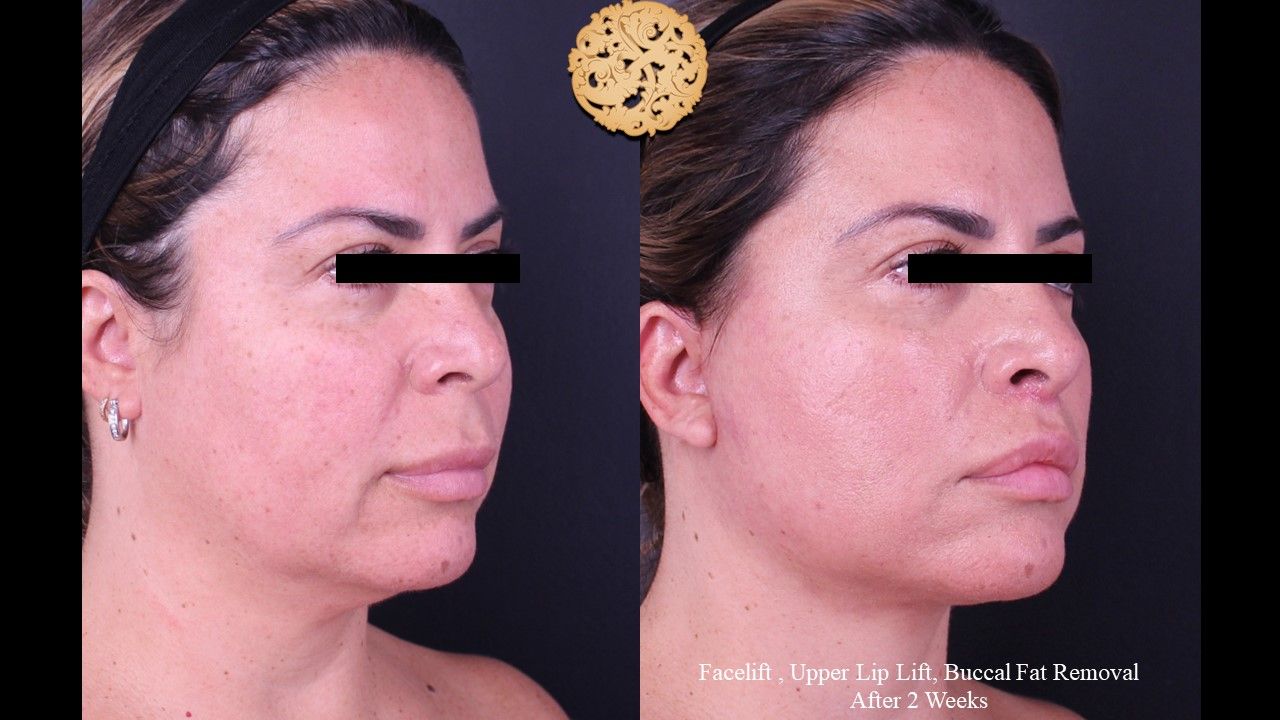 Facelift Neck Lift Before & After