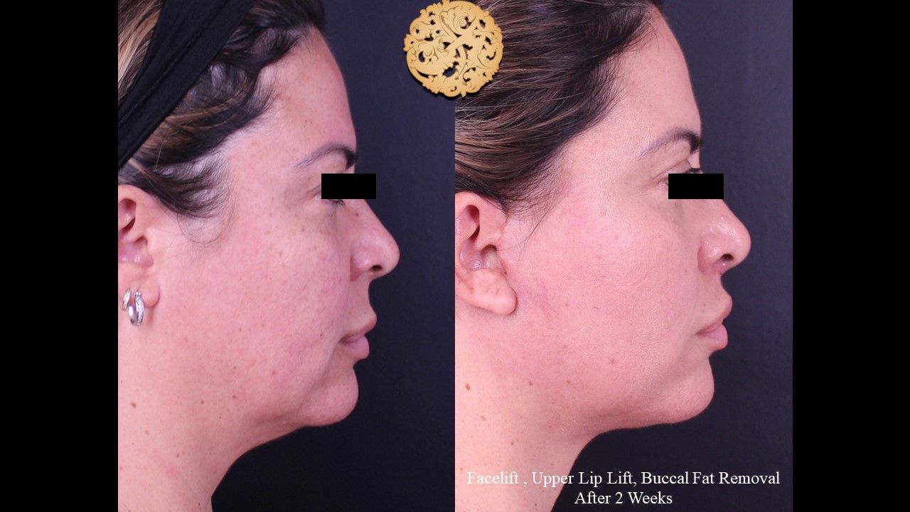 Facelift Neck Lift Before & After