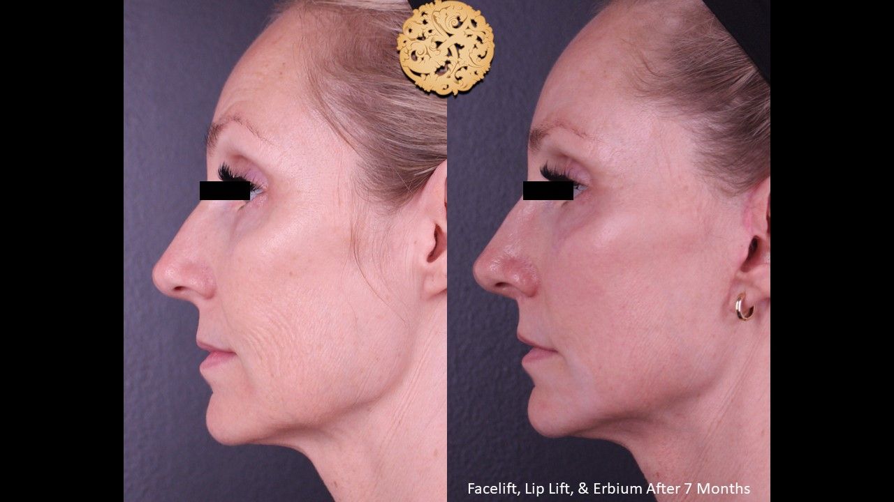 Facelift Neck Lift Before & After