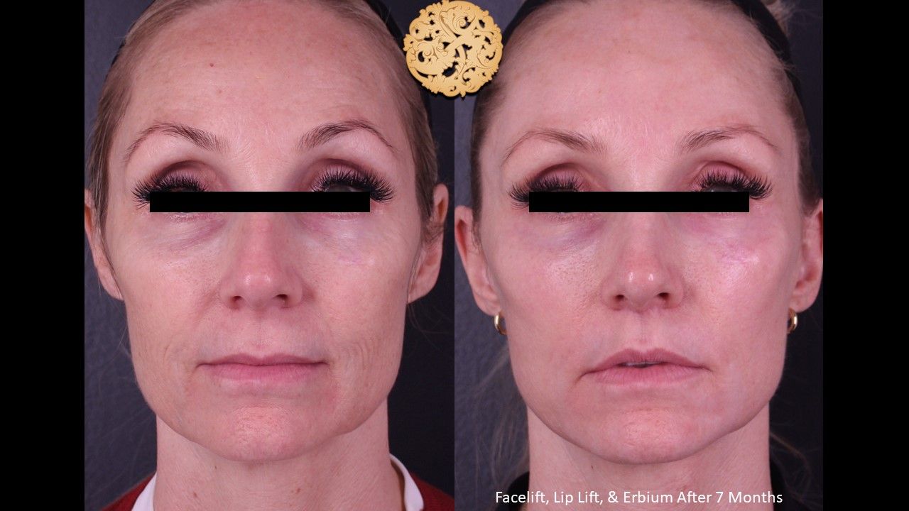 Facelift Neck Lift Before & After