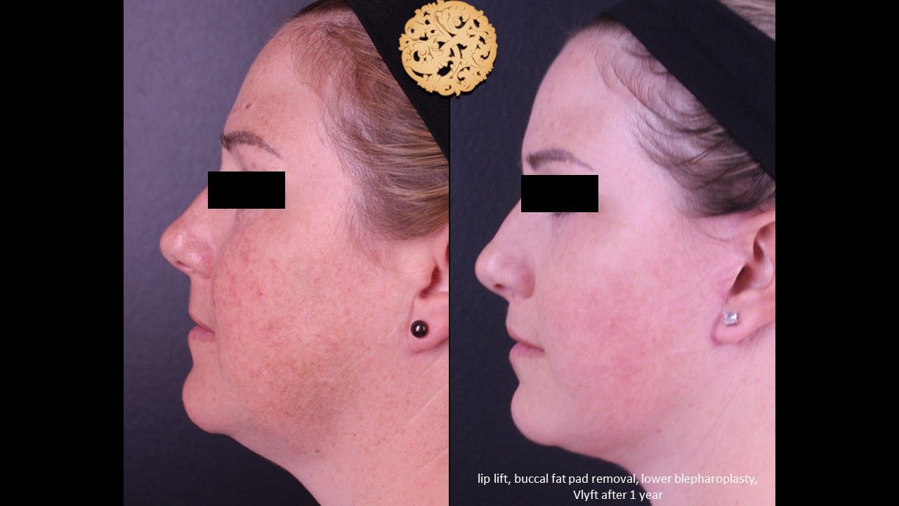 Facelift Neck Lift Before & After