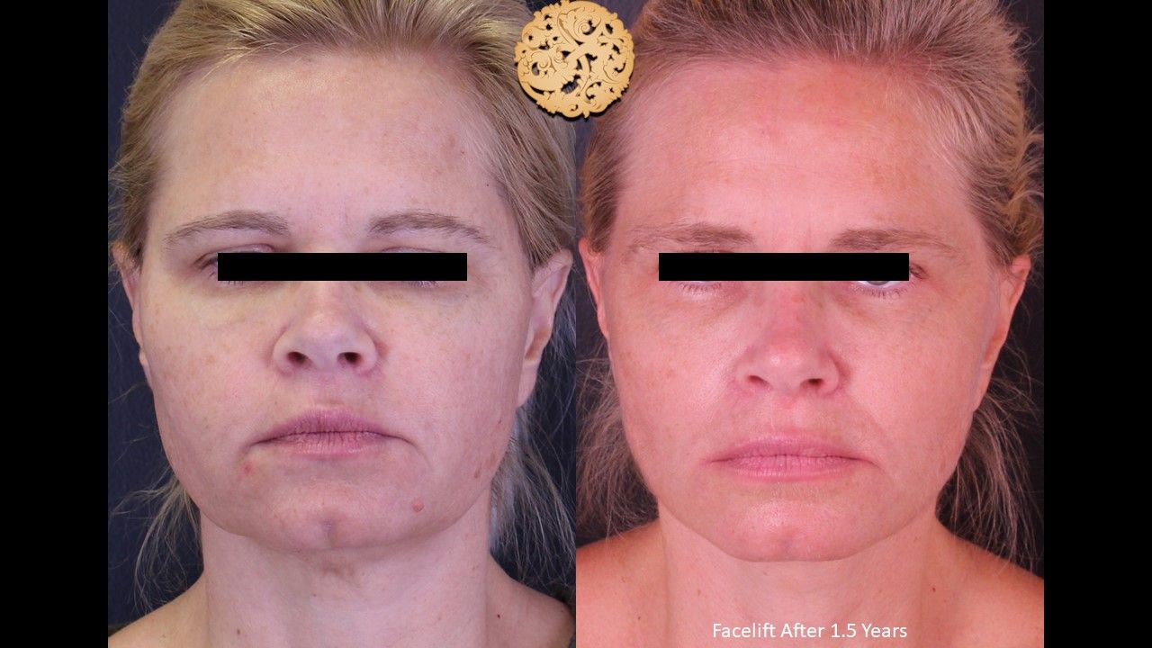 Facelift Neck Lift Before & After