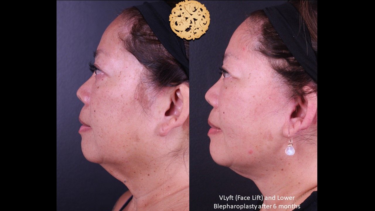 Facelift Neck Lift Before & After