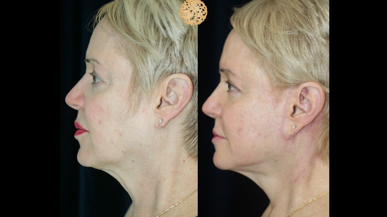 Facelift Neck Lift Before & After