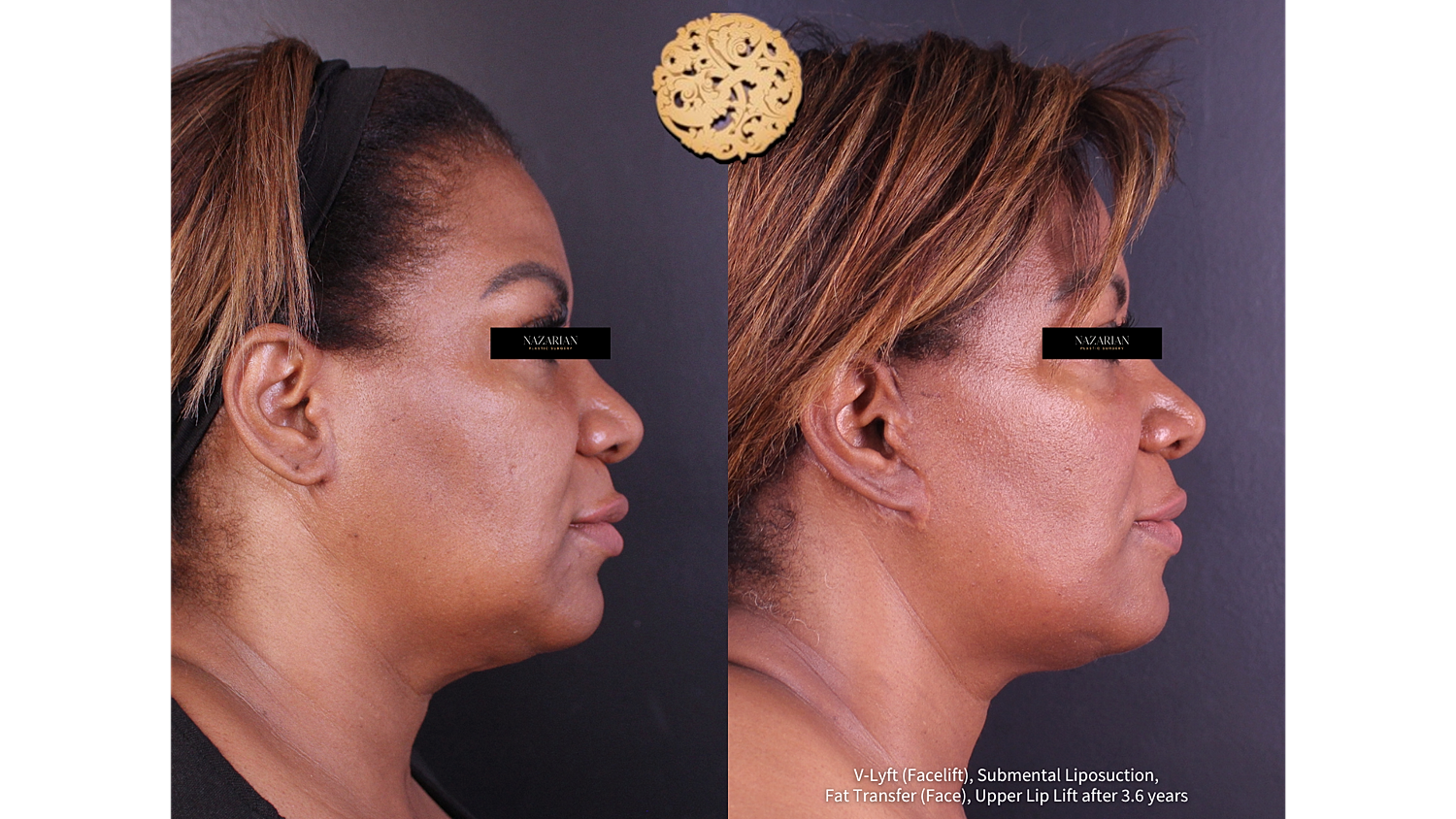 Before and after facial cosmetic procedures comparison.
