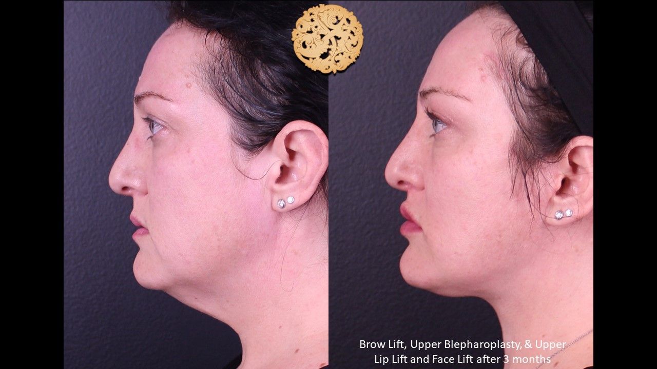 Facelift Neck Lift Before & After
