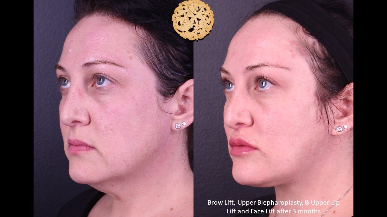 Facelift Neck Lift Before & After