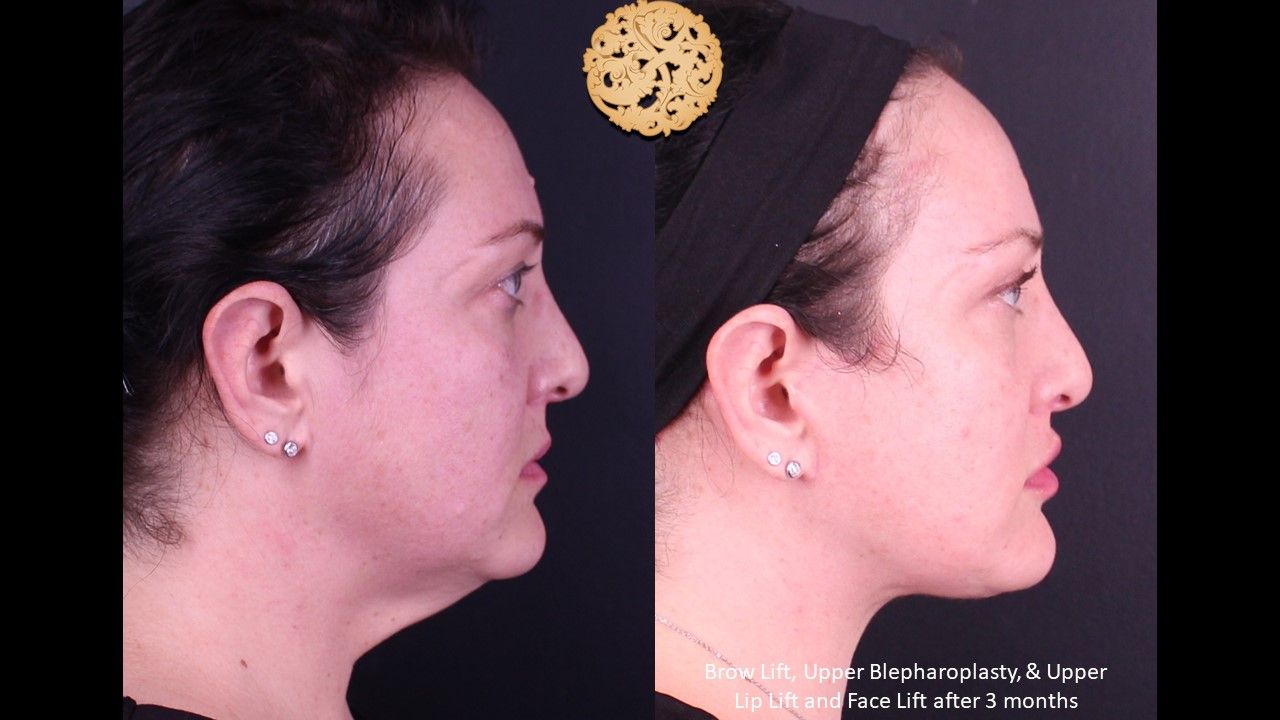 Facelift Neck Lift Before & After