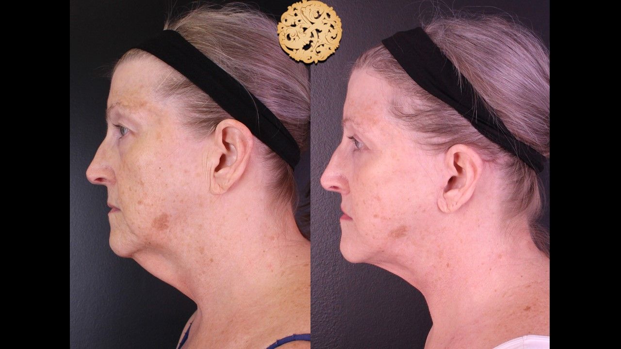 Facelift Neck Lift Before & After