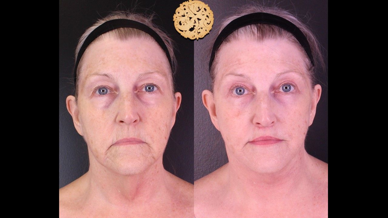 Facelift Neck Lift Before & After