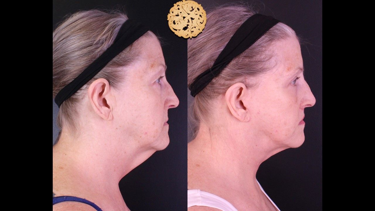 Facelift Neck Lift Before & After