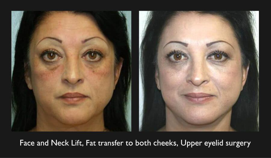 Facelift Neck Lift Before & After