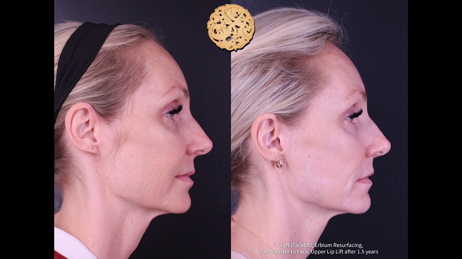 Before and after facial rejuvenation treatment comparison.