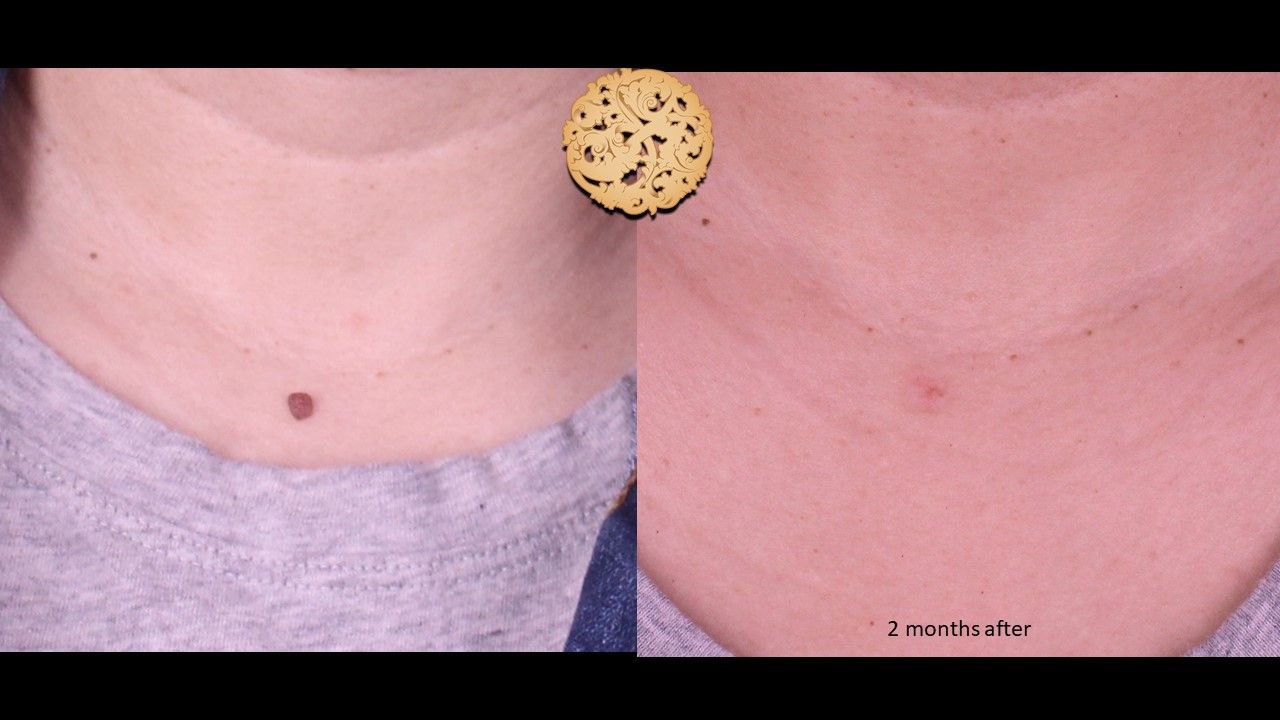 Mole Keloid Removal Before & After