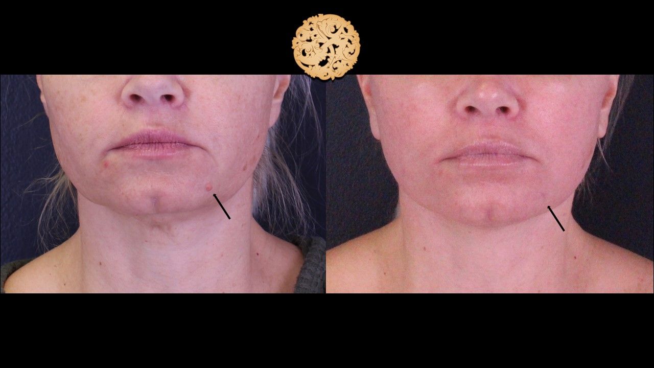 Mole Keloid Removal Before & After