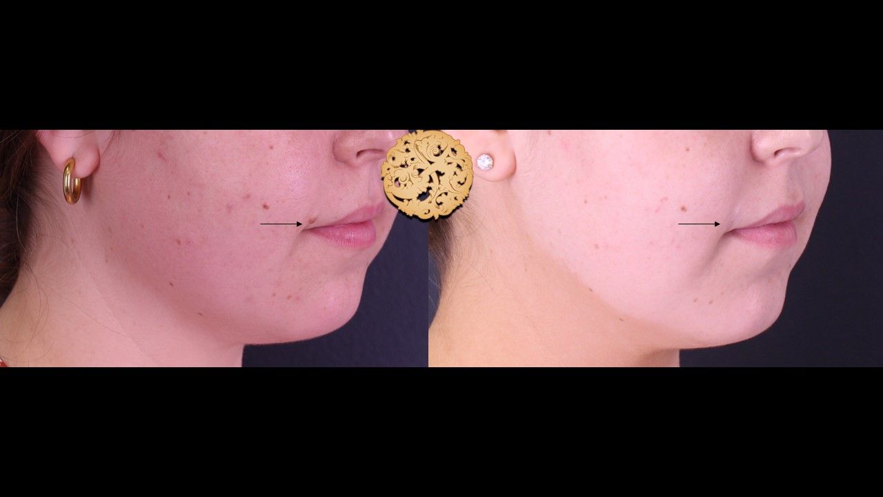 Mole Keloid Removal Before & After