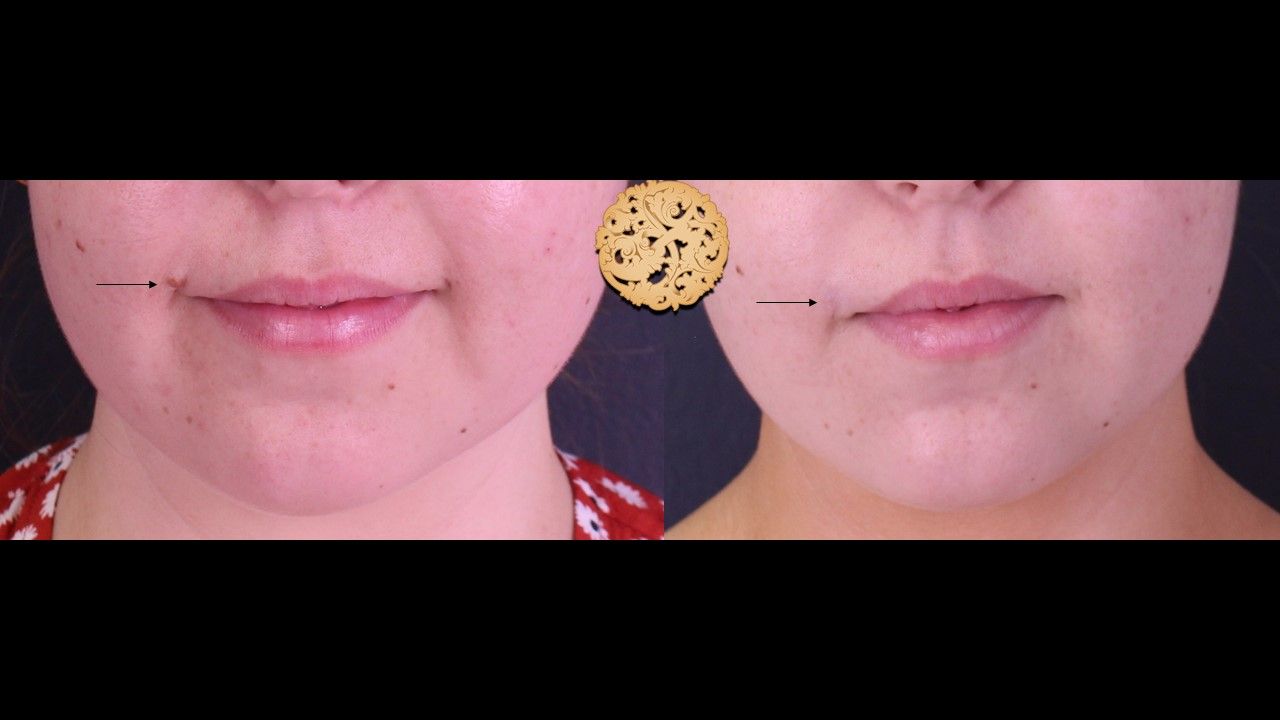 Mole Keloid Removal Before & After