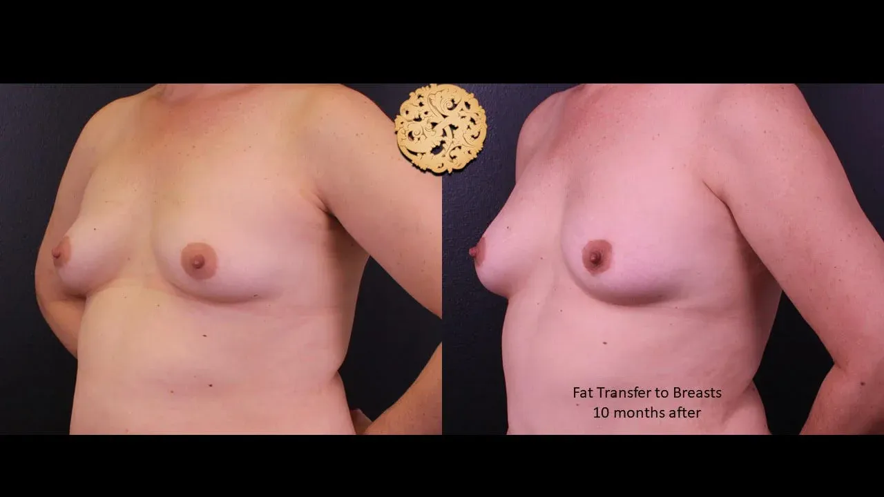 Facial Fat Transfer Before & After