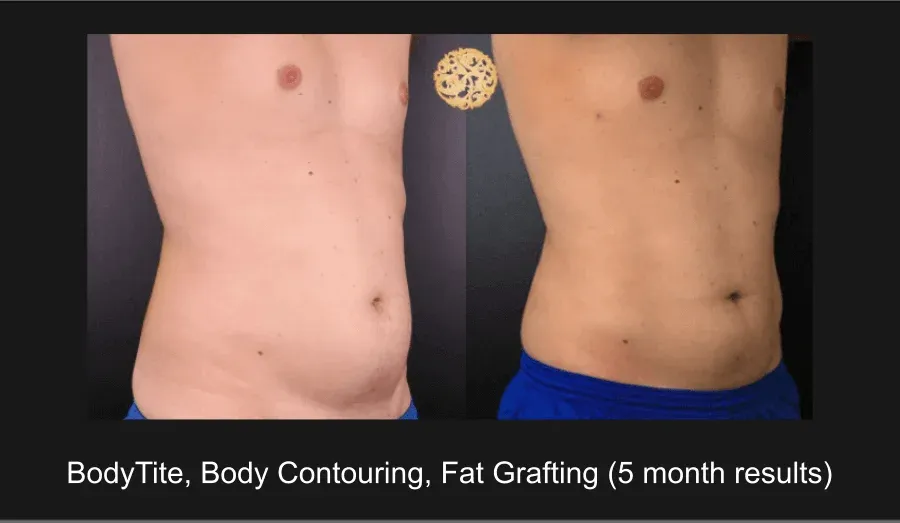 Facial Fat Transfer Before & After