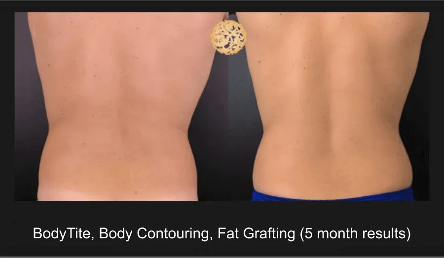 Facial Fat Transfer Before & After