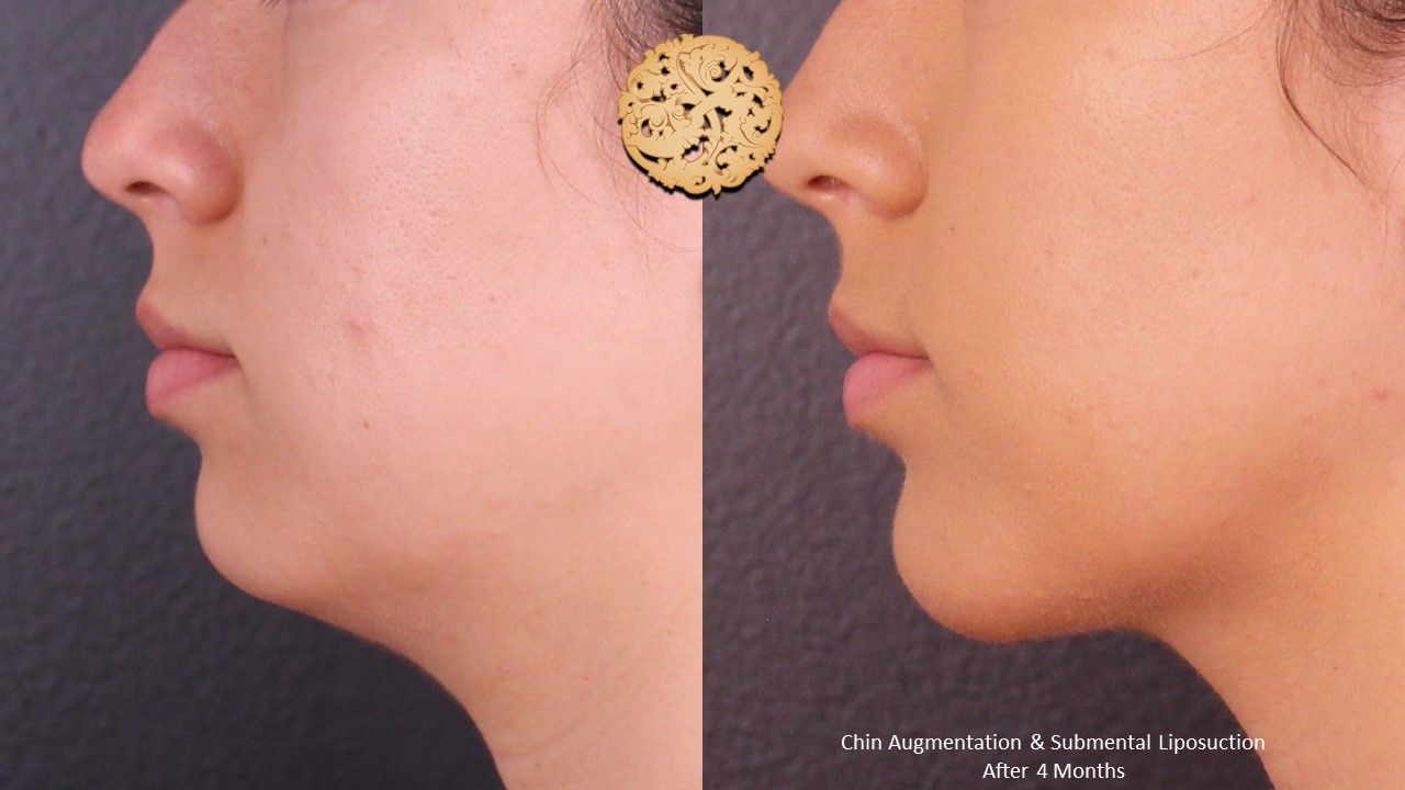 Chin Implant Before & After