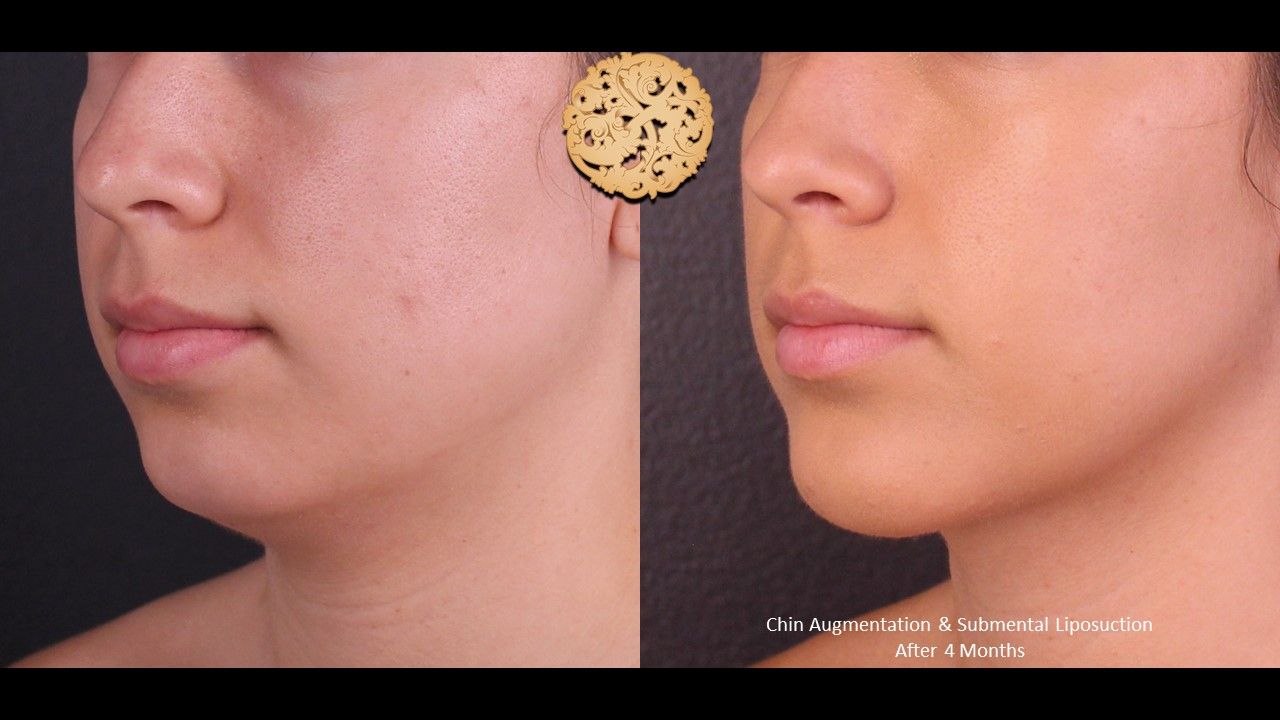 Chin Implant Before & After