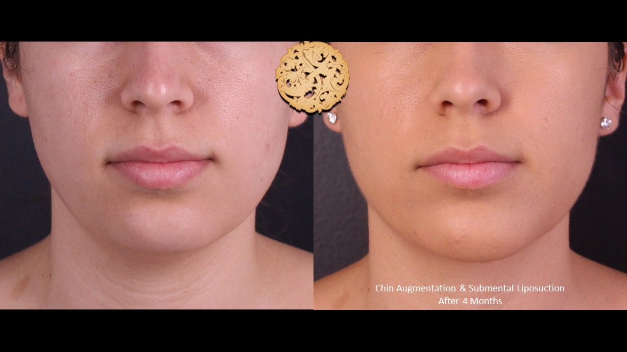 Chin Implant Before & After