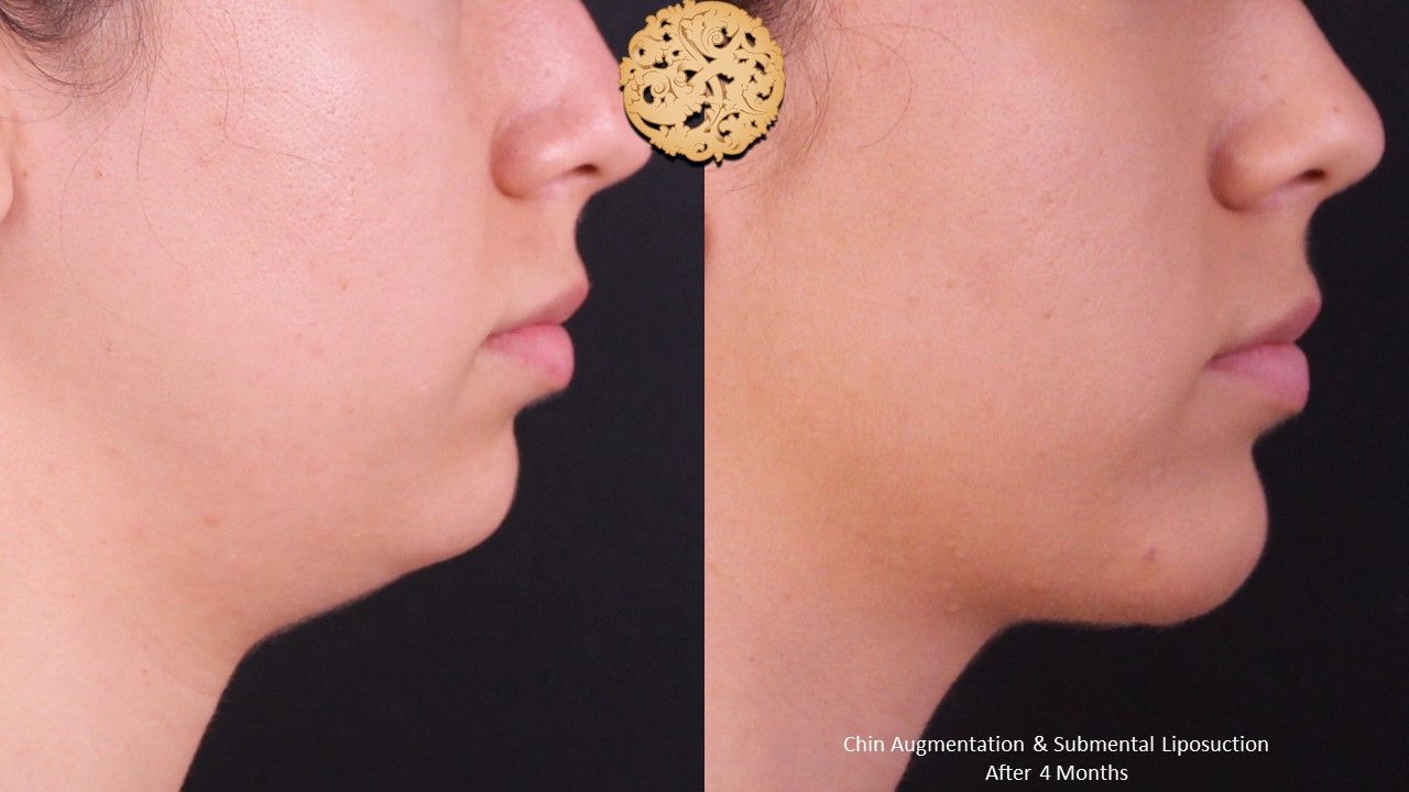 Chin Implant Before & After