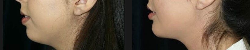 Chin Implant Before & After