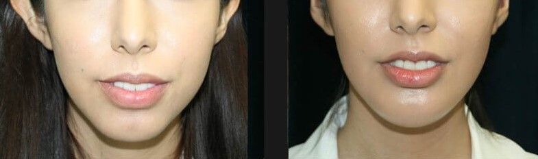 Chin Implant Before & After