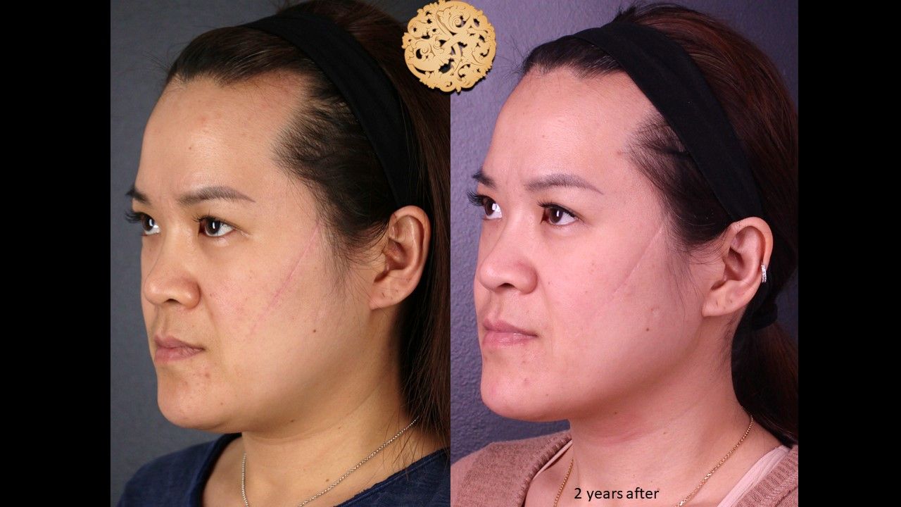 Scar Treatment Before & After