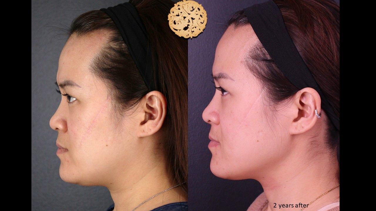 Scar Treatment Before & After