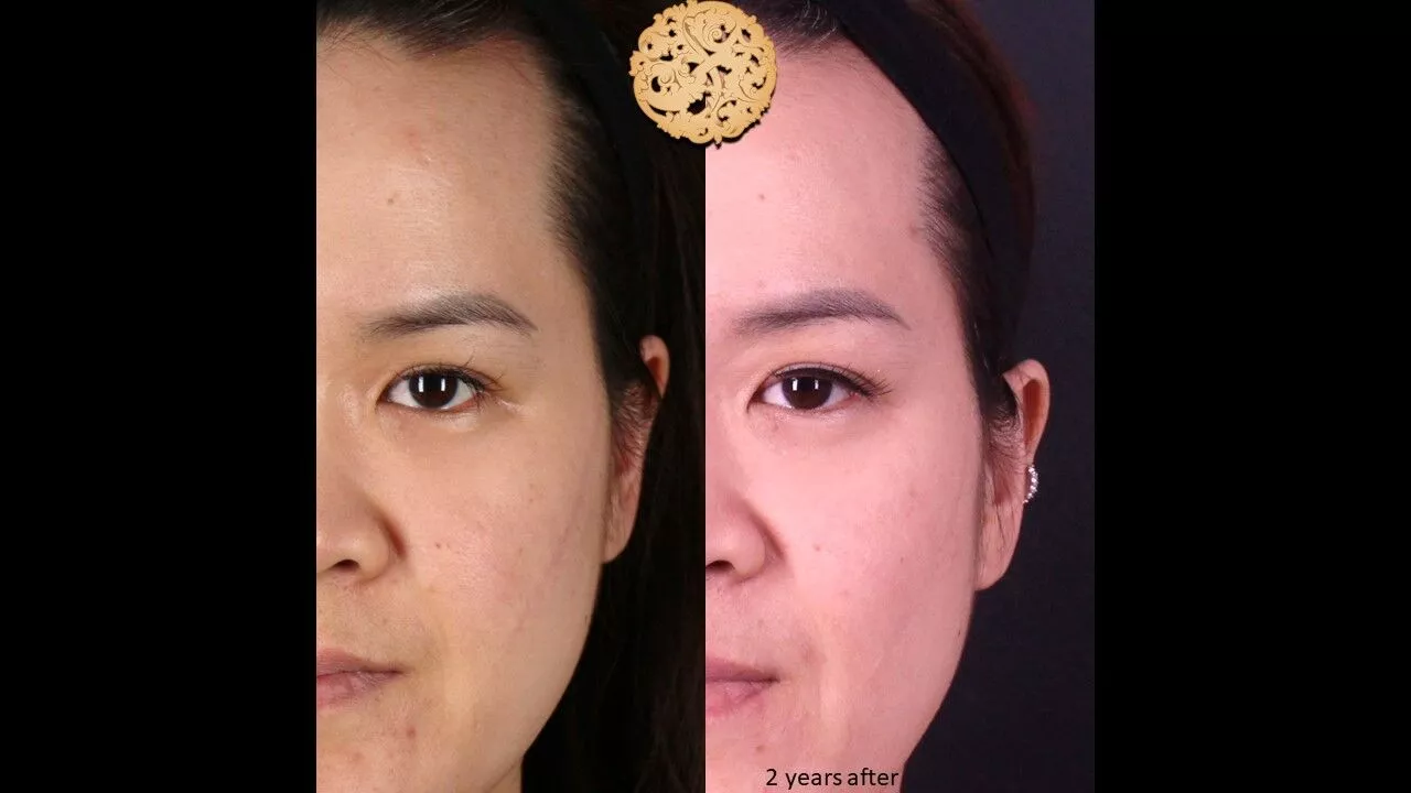 Skin Texture Before & After