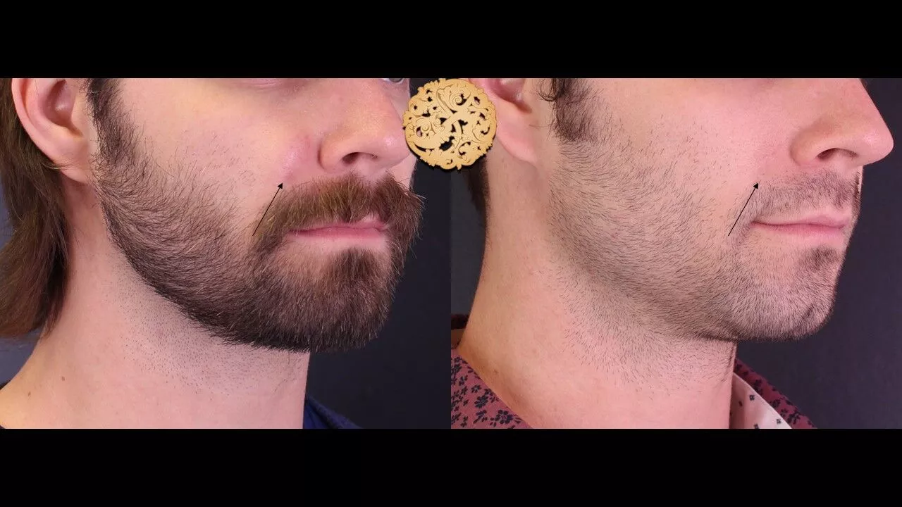 Skin Texture Before & After