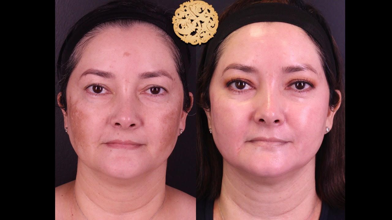 Skin Texture Before & After