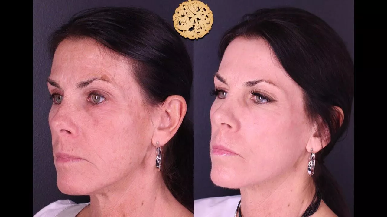 Skin Texture Before & After
