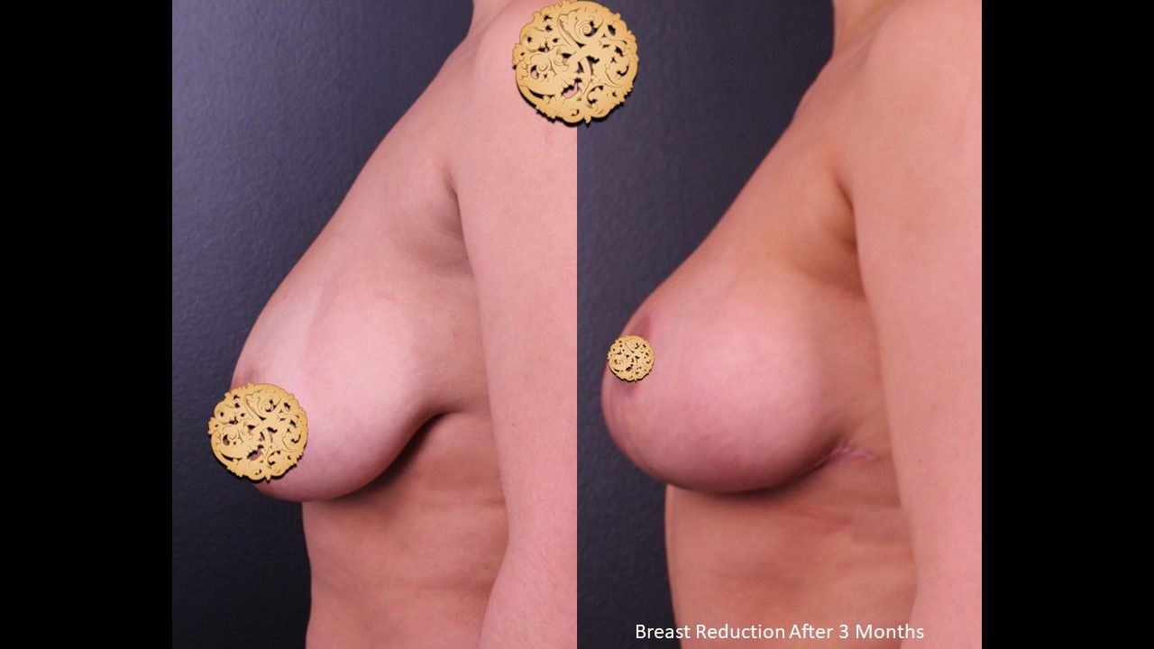 Breast Reduction Before & After