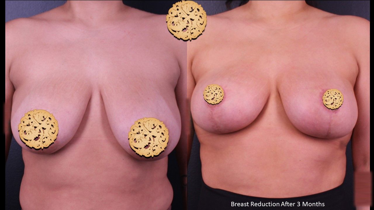 Breast Reduction Before & After