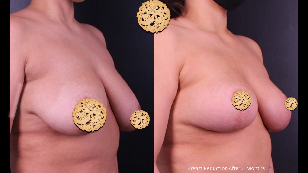 Breast Reduction Before & After