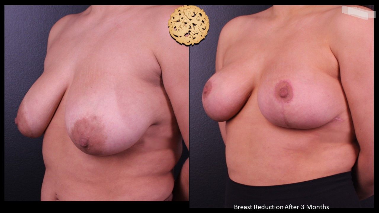 Breast Reduction Before & After