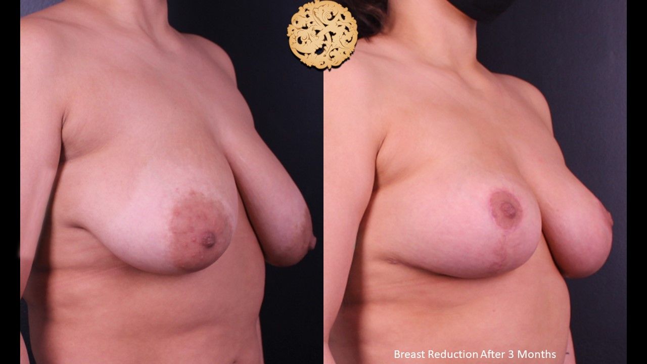 Breast Reduction Before & After